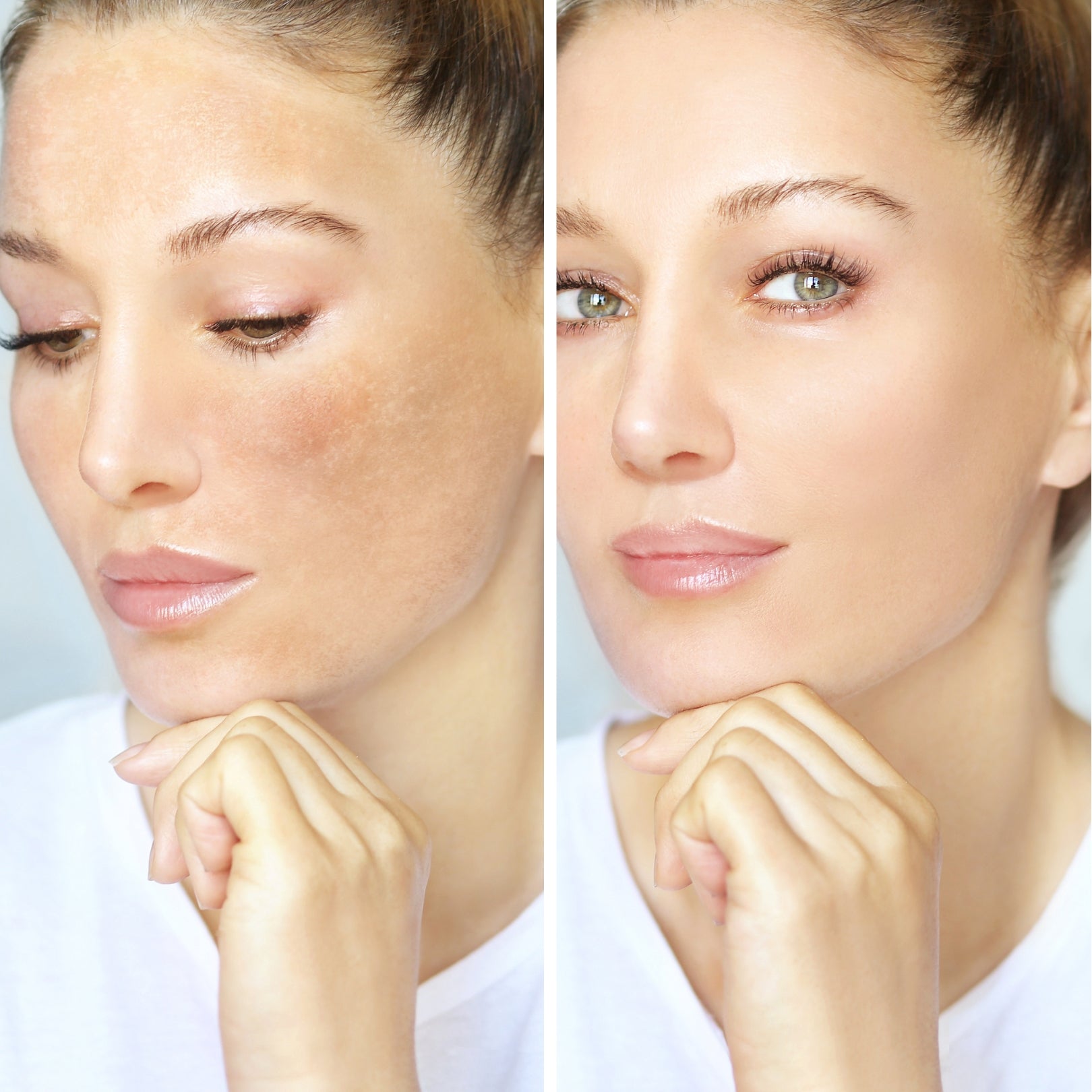 melasma cream