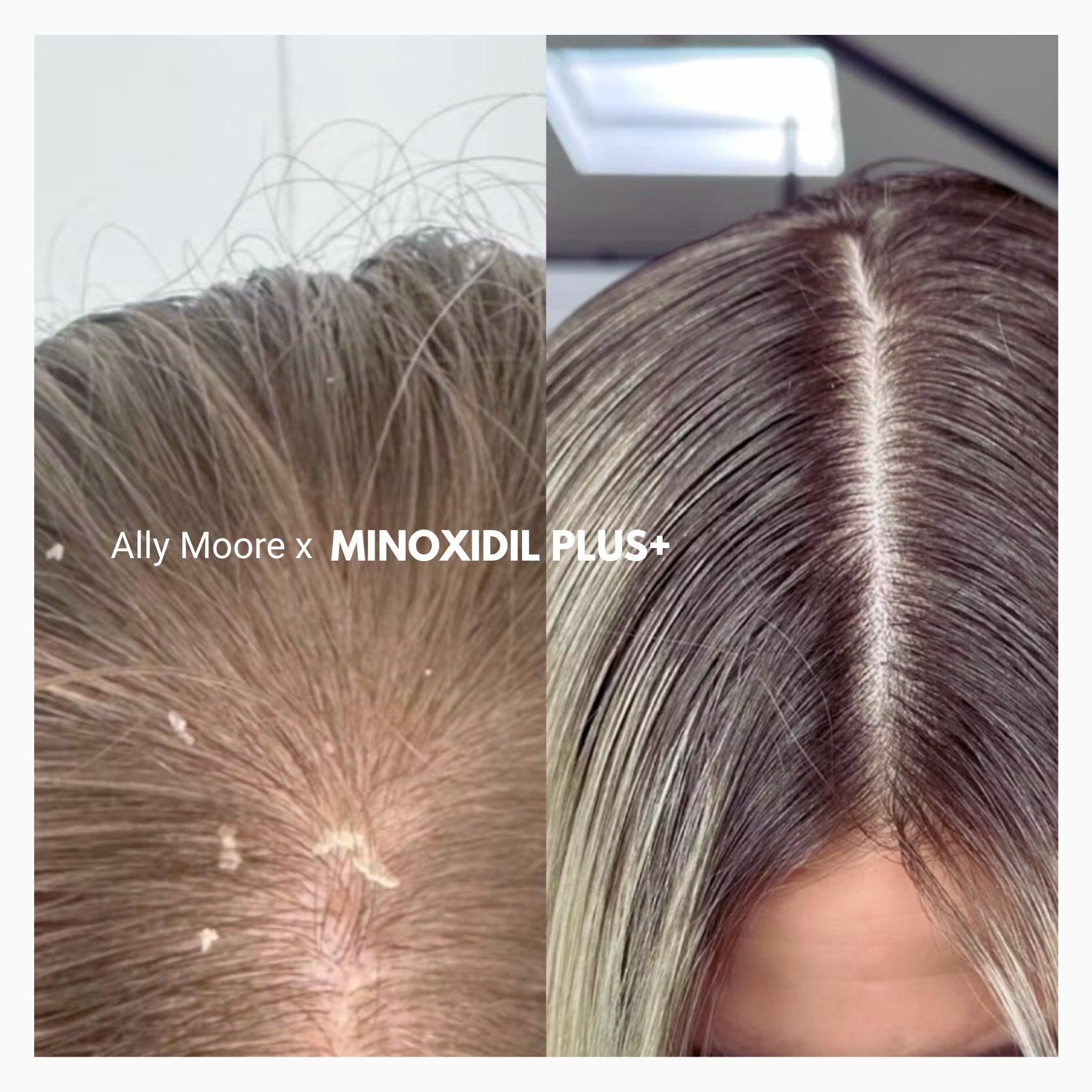 minoxidil plus+