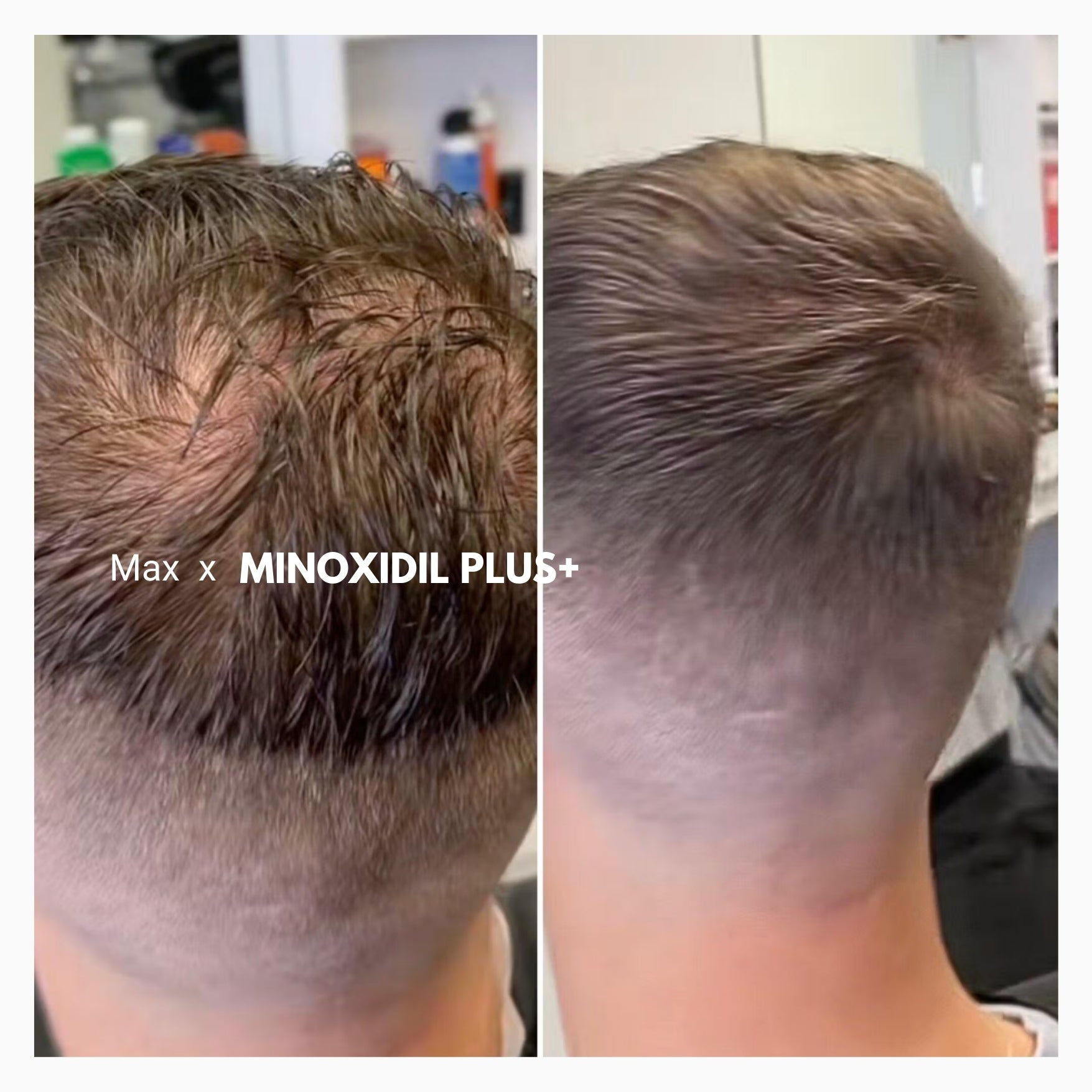 minoxidil plus+