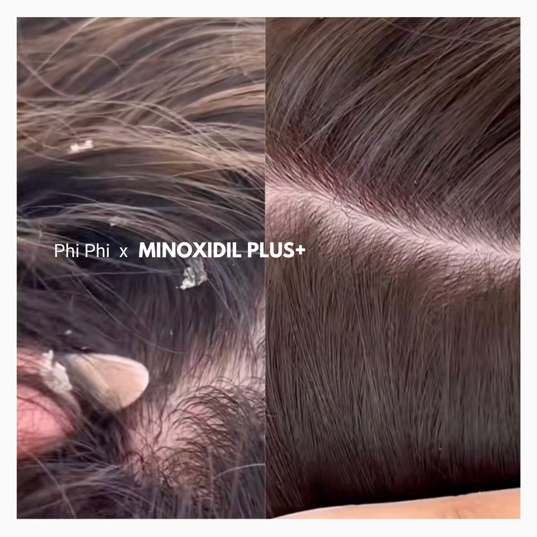 minoxidil plus+
