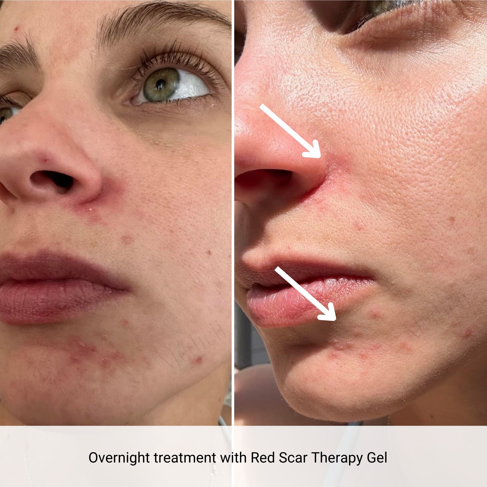 red acne marks