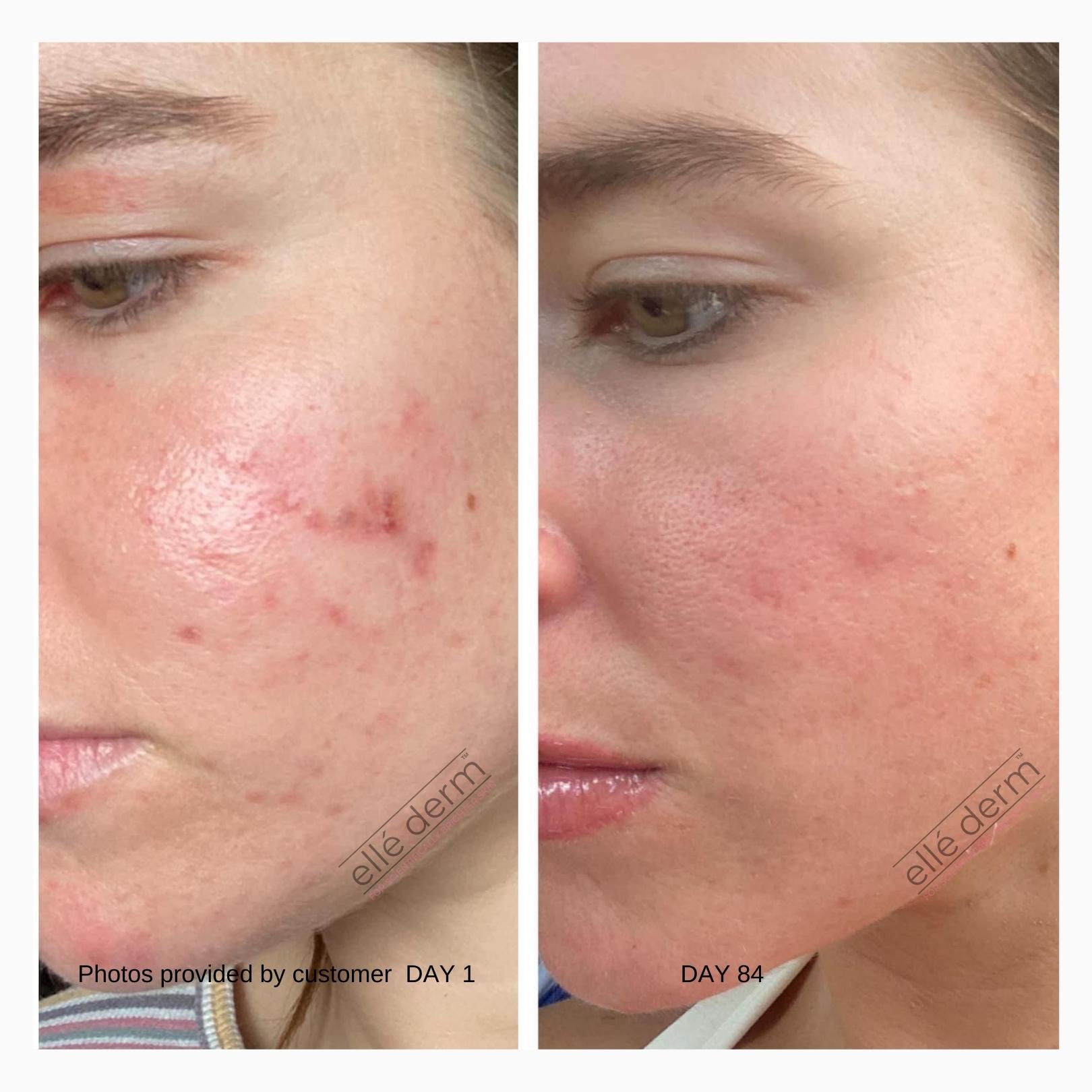 acne scar removal