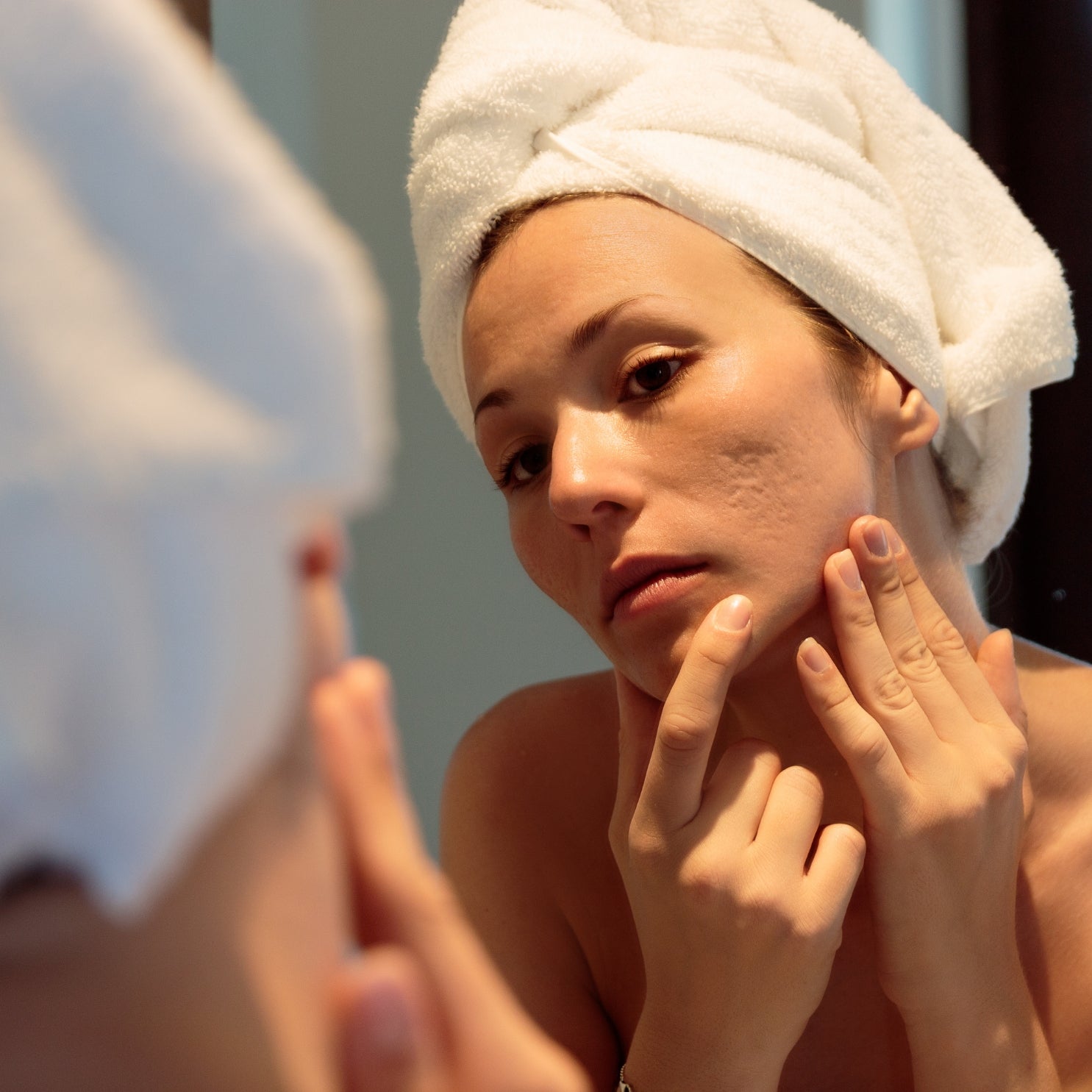 adult hormonal acne