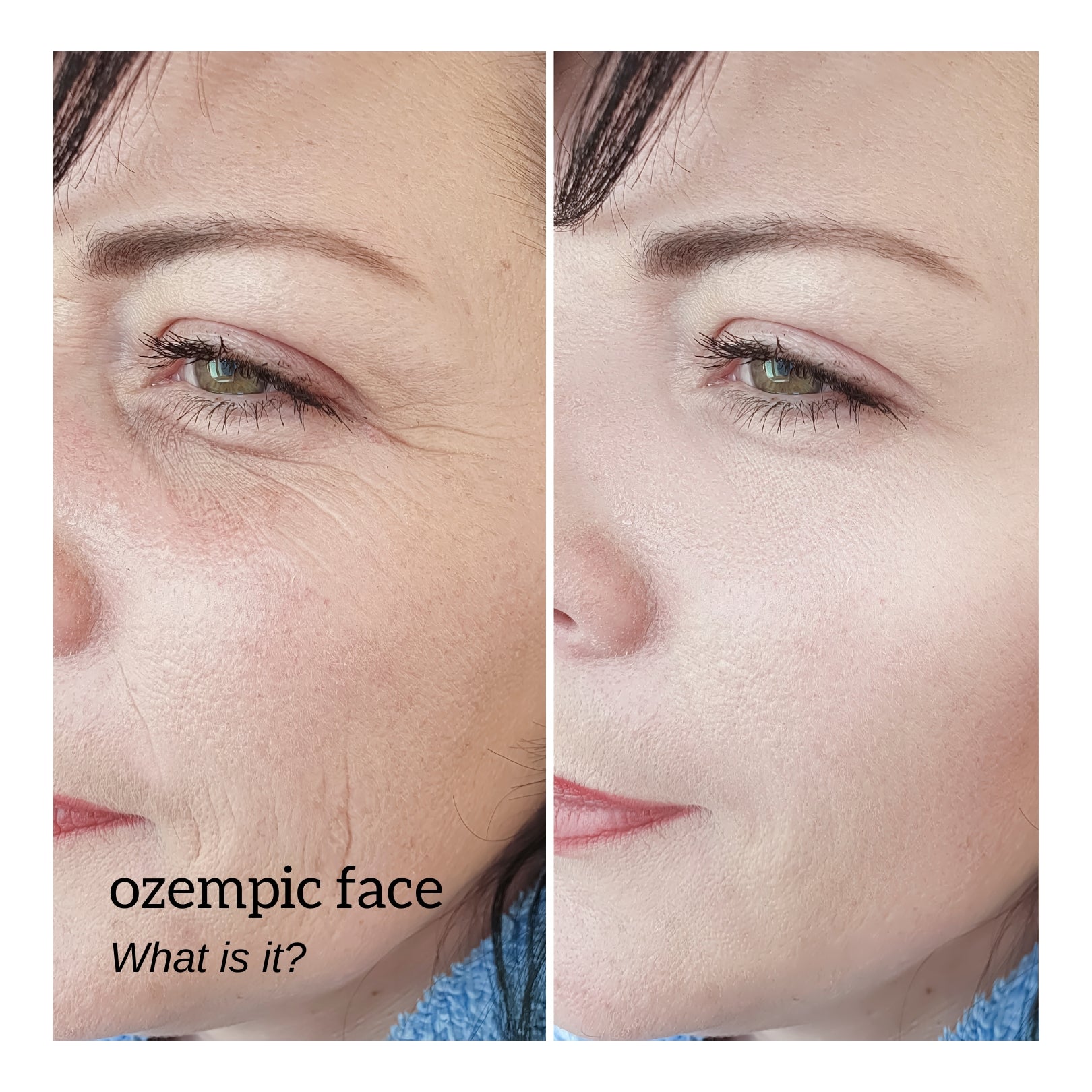 Ozempic face - the beauty trend no one saw coming
