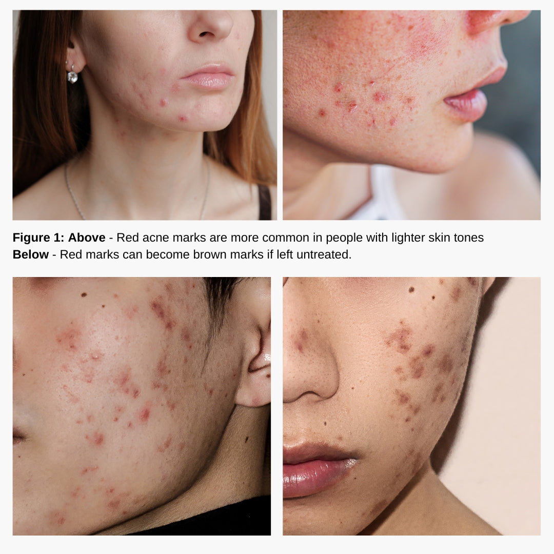 How to get rid of hormonal acne