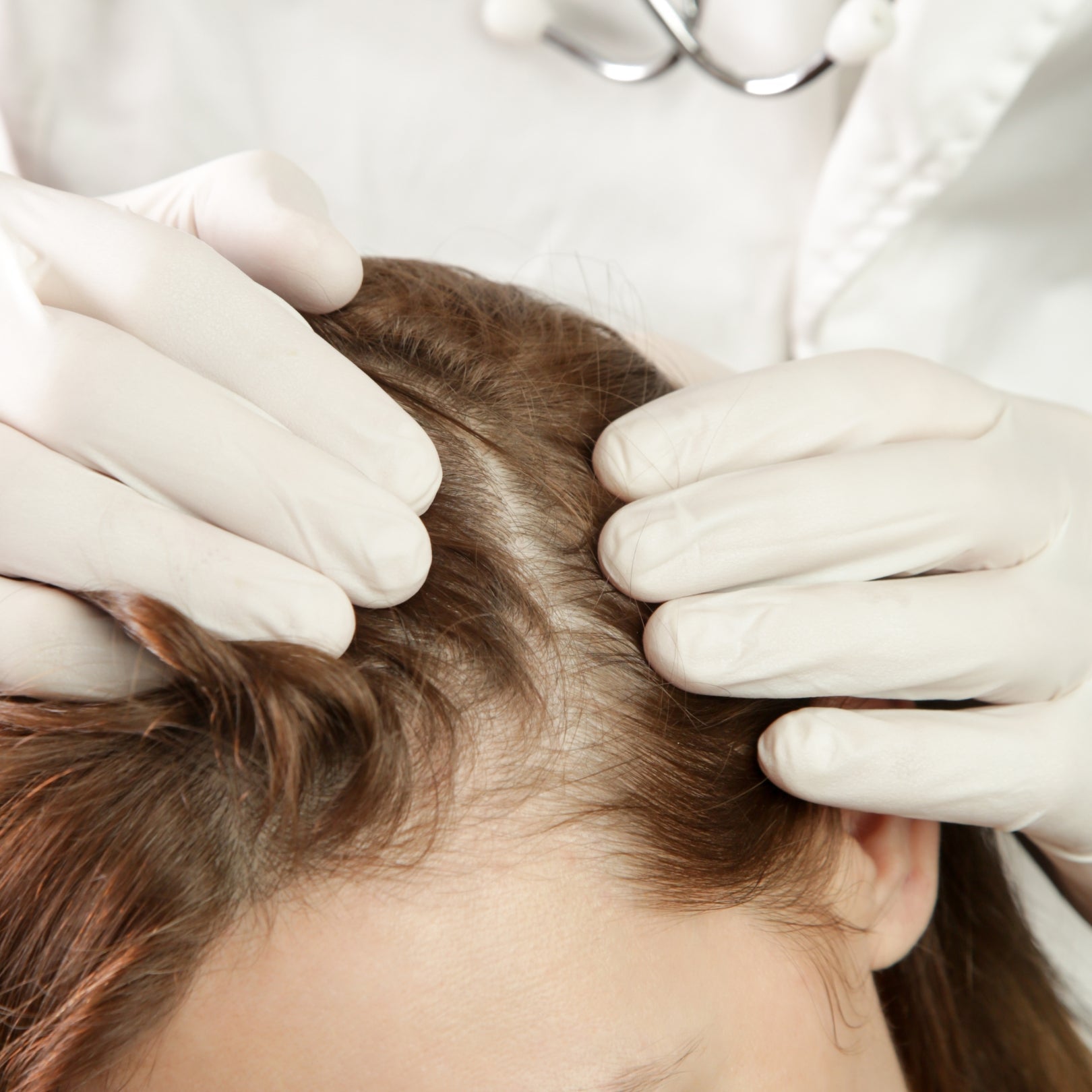 Why does it itch after I apply minoxidil to my hair?