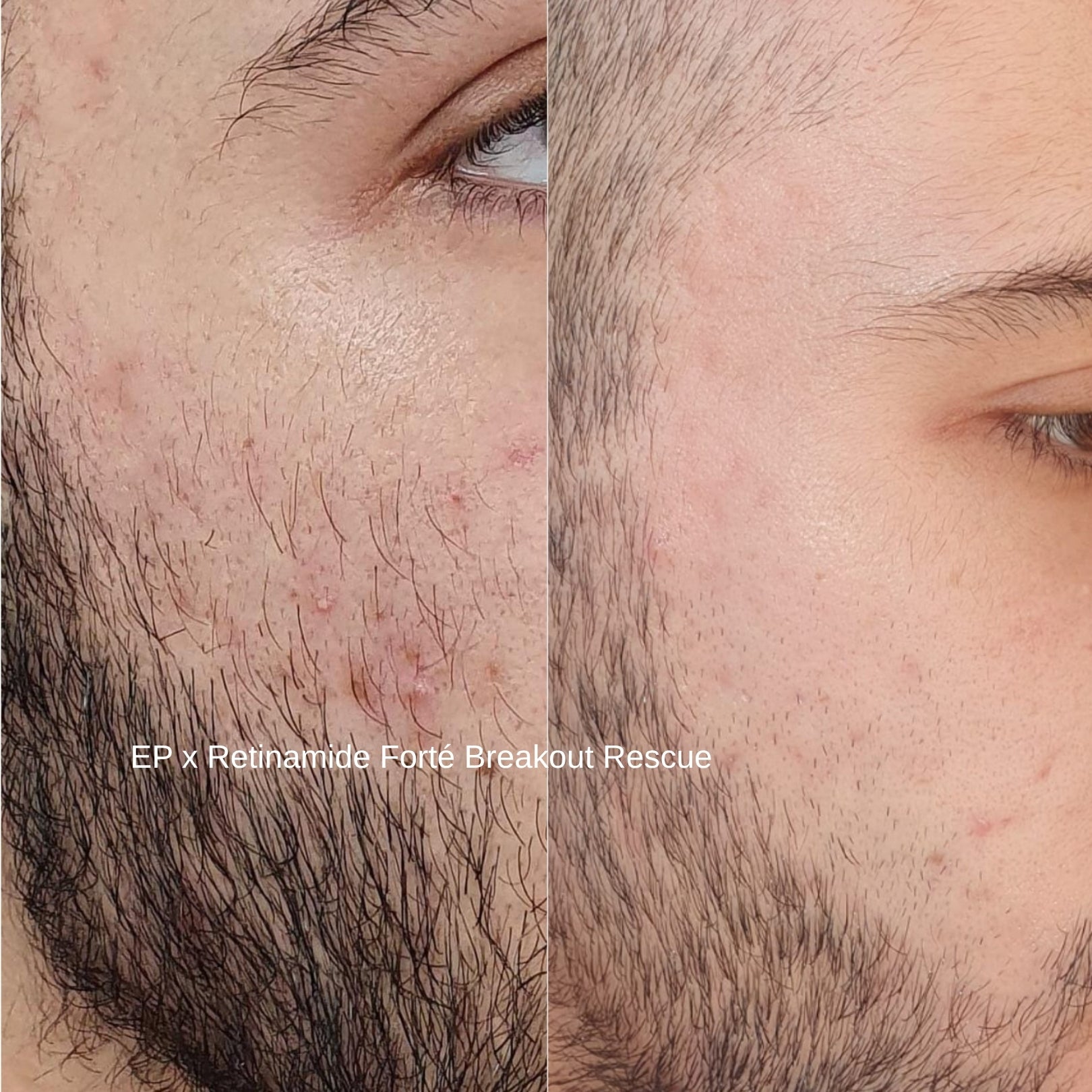 retinamide forte breakout rescue