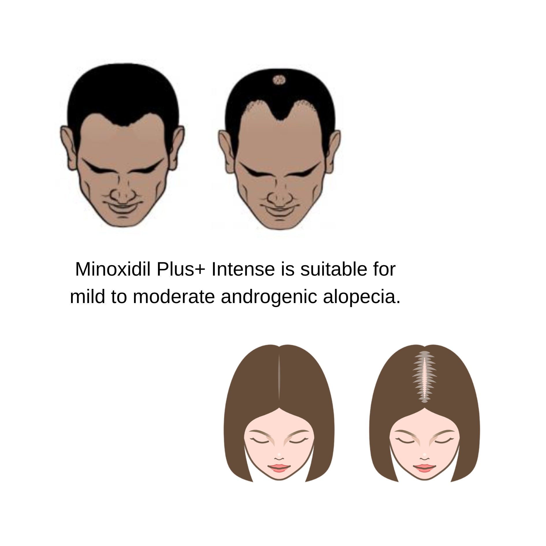 androgenic alopecia