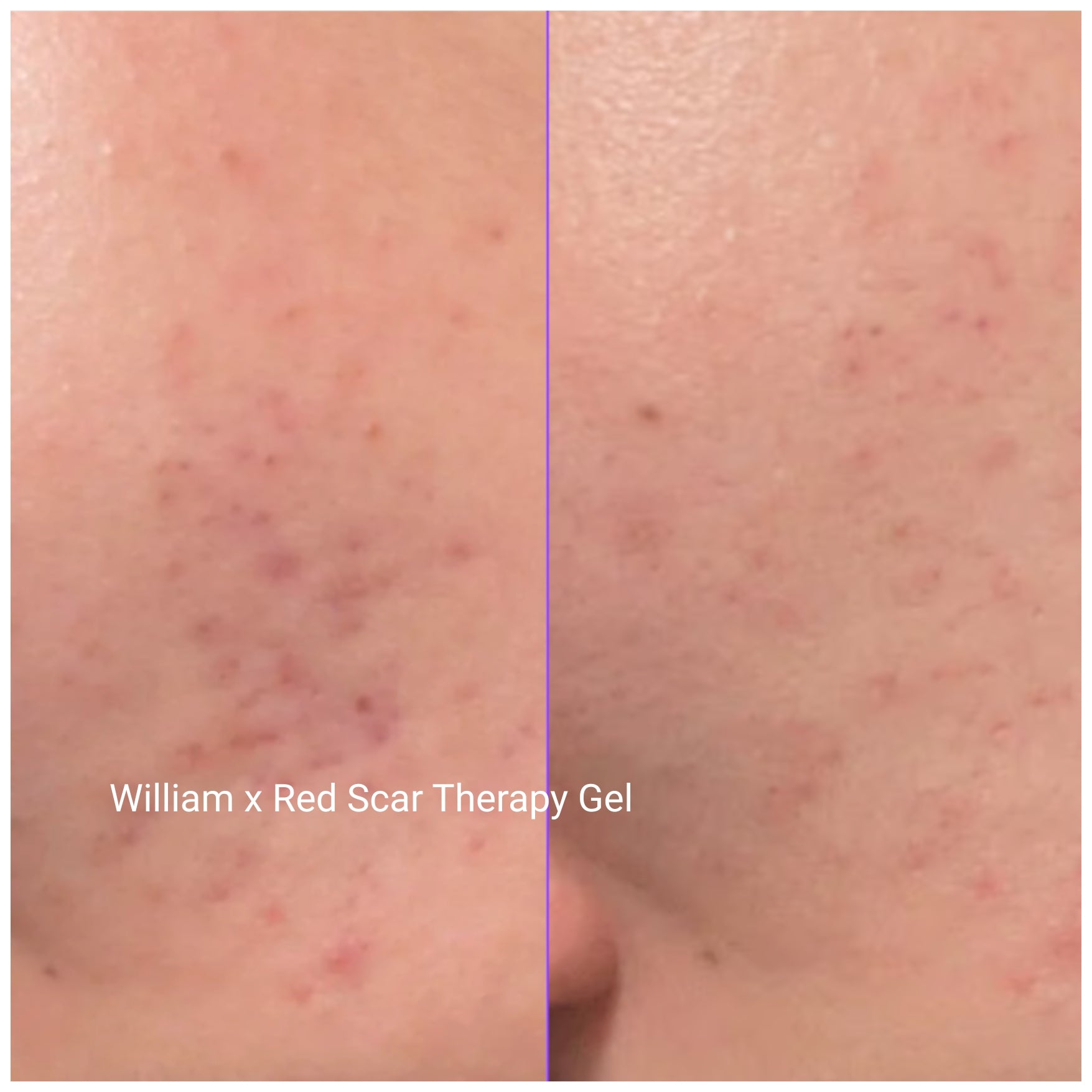 Red Scar Therapy Gel 30g