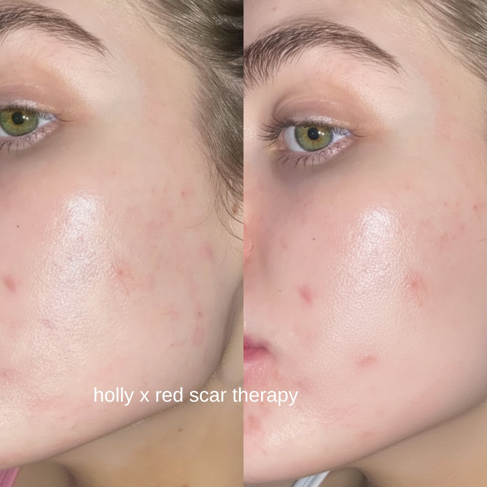 Red Scar Therapy Gel 30g