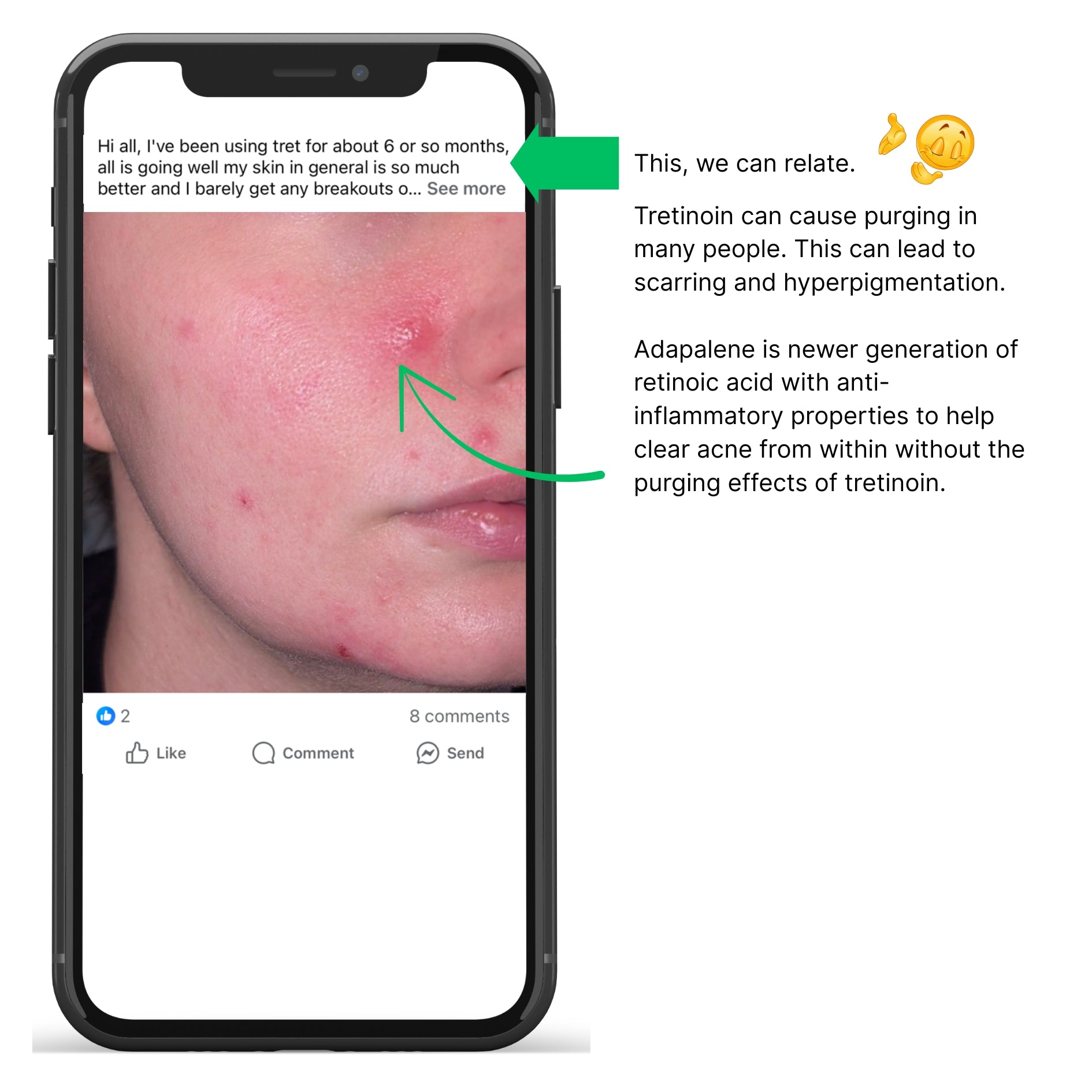 tretinoin purge